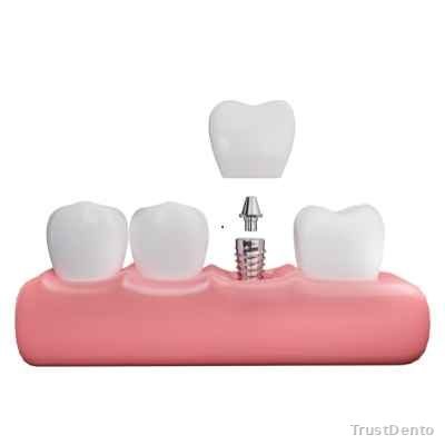 Dental Bridge Cost dental treatment illustration
