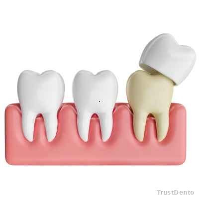 Dental Crown Cost dental treatment illustration