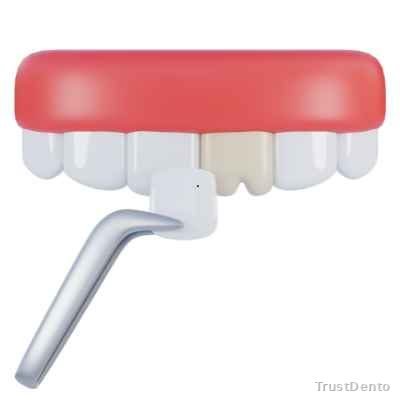 Dental Veneers Cost dental treatment illustration