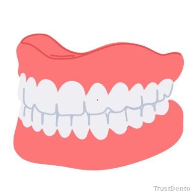 Dentures Cost dental treatment illustration