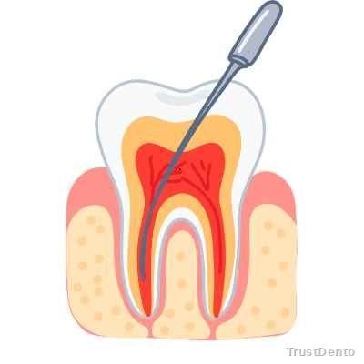 Endodontics (Root Canal) dental treatment illustration