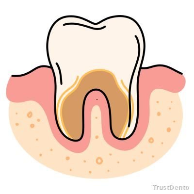 Gum Disease Treatment Cost dental treatment illustration