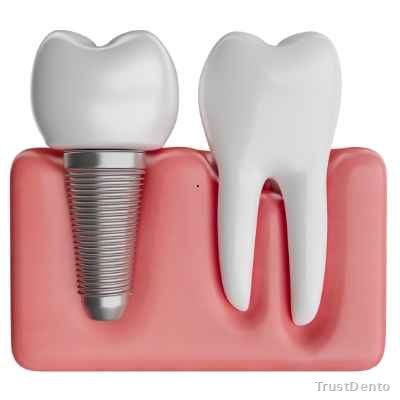 Implantology dental treatment illustration
