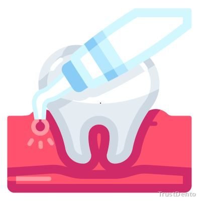 Laser Dentistry dental treatment illustration