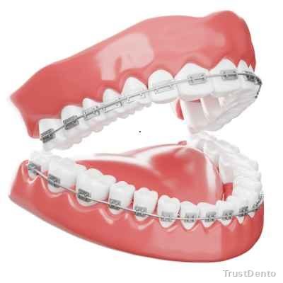 Orthodontic Treatment Cost dental treatment illustration