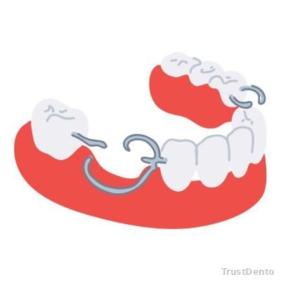 Prosthodontics dental treatment illustration