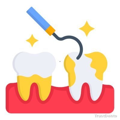 Teeth Scaling Cost dental treatment illustration