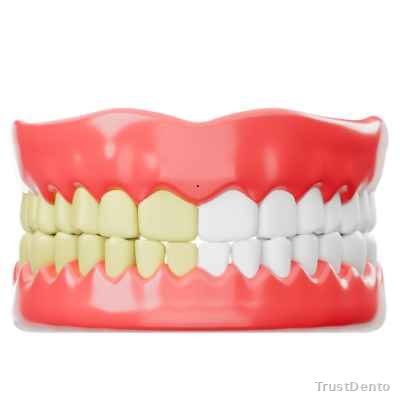 Teeth whitening  Cost dental treatment illustration