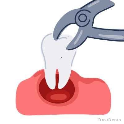 Tooth Extraction dental treatment illustration
